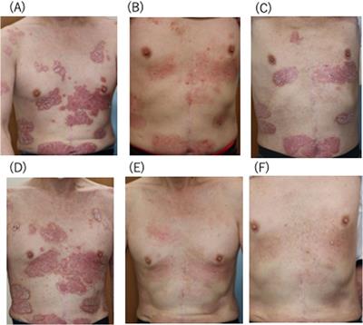 Successful treatment by deucravacitinib of psoriasis refractory to apremilast